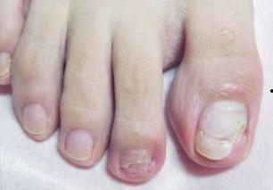 网红灰指甲,揭秘指甲健康与美丽背后的秘密